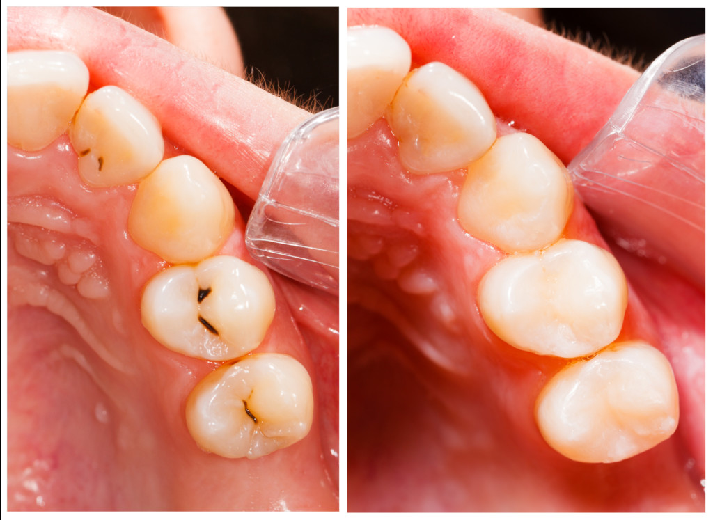 Teeth before and after treatment - dental composite filling. cosmetic and restorative dentistry.