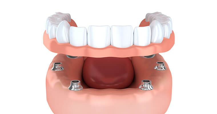 Model showing All-on-4 denture-supported implants