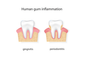 Human gum inflammation.