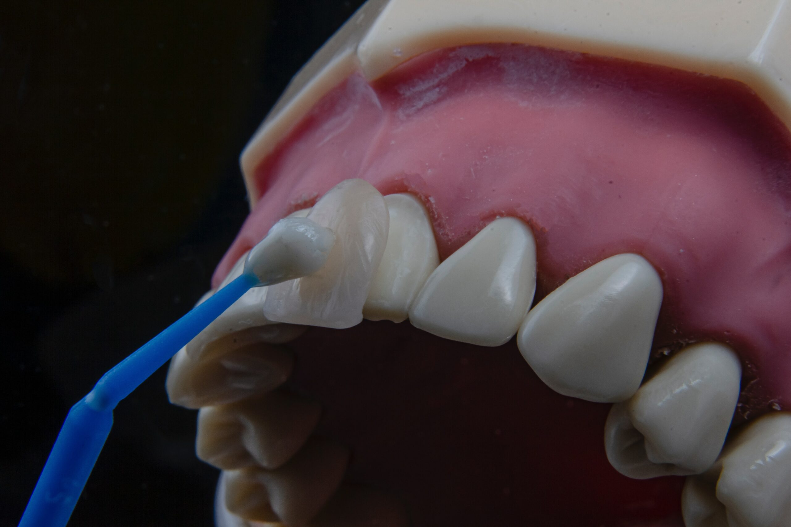 Dental veneer placed against a tooth